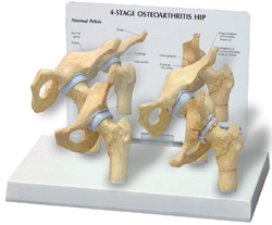 Hip Joint Osteoarthiritis - 4Stage Pharmaceutical and Anatomical Model Gifts